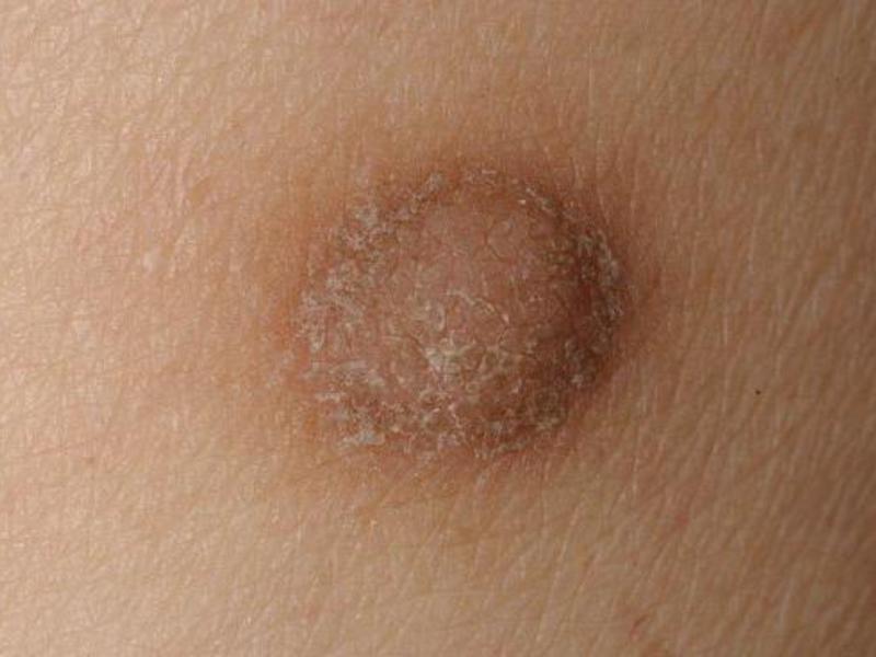 Фиброма кожи фото фиброма
