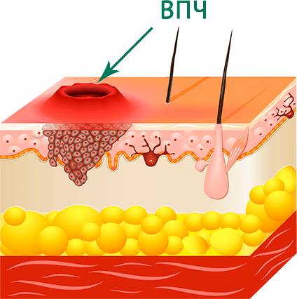 Вирус папилломы человека