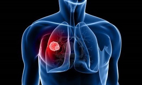 Проблема туберкулеза Проблема туберкулеза