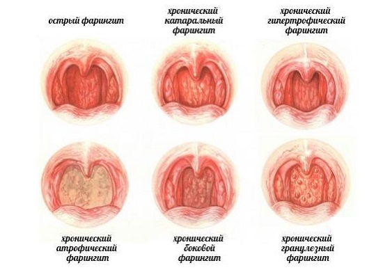 Формы хронического фарингита Формы хронического фарингита