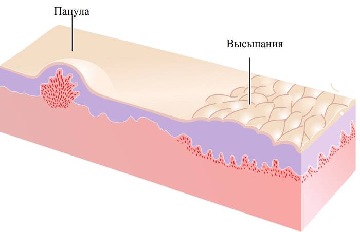 Папула - первичное аллергическое высыпание на коже Папула - первичное аллергическое высыпание на коже