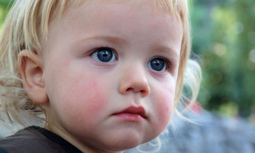 Проблема аллергического диатеза Проблема аллергического диатеза