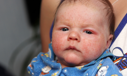 Атопический дерматит у детей Атопический дерматит у детей