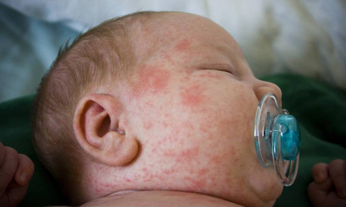 Проблема аллергии у грудничков Проблема аллергии у грудничков