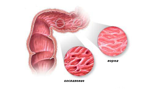 Проблема болезни Крона Проблема болезни Крона