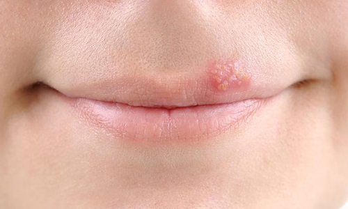 Запрет на закаливание при герпесе Запрет на закаливание при герпесе