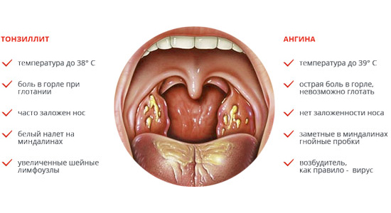 Симптомы тонзиллита и ангины Симптомы тонзиллита и ангины
