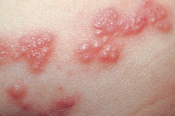 Сыпь на коже - противопоказание для проведения кожной пробы Сыпь на коже - противопоказание для проведения кожной пробы