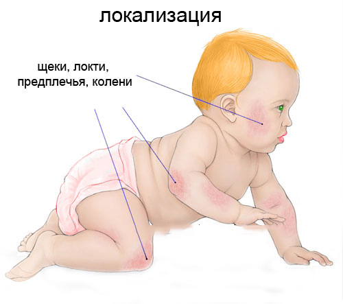 Зоны высыпаний при аллергии Зоны высыпаний при аллергии