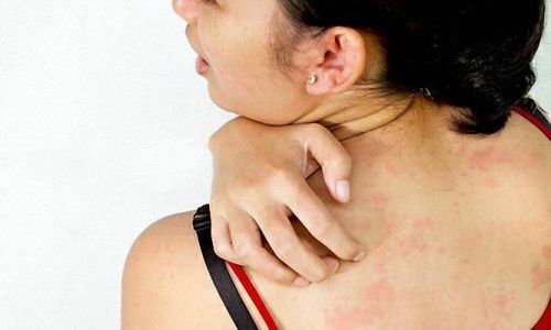 Проблема аллергии на молоко Проблема аллергии на молоко