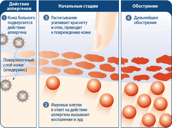 Схема развития аллергии Схема развития аллергии