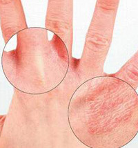 Шелушение кожи на руках Шелушение кожи на руках