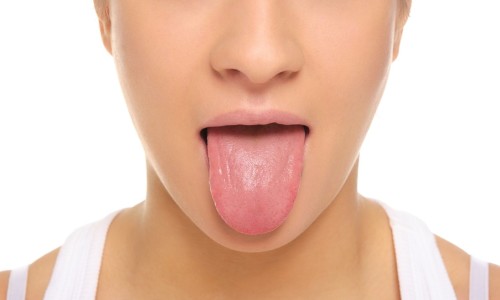 Отек языка - симптом аллергии на шоколад Отек языка - симптом аллергии на шоколад