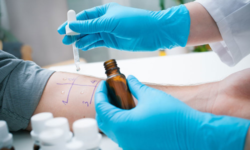 Кожные пробы для определения источников аллергии Кожные пробы для определения источников аллергии