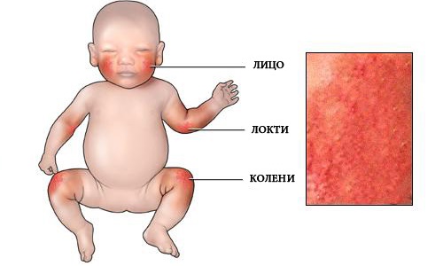 Места проявления аллергии у детей Места проявления аллергии у детей
