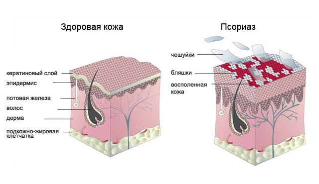 Псориаз в пожилом возрасте Псориаз в пожилом возрасте