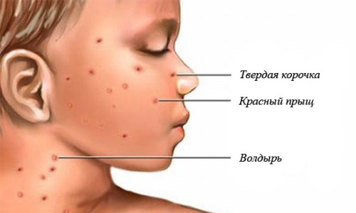 Проблема ветрянки у детей Проблема ветрянки у детей